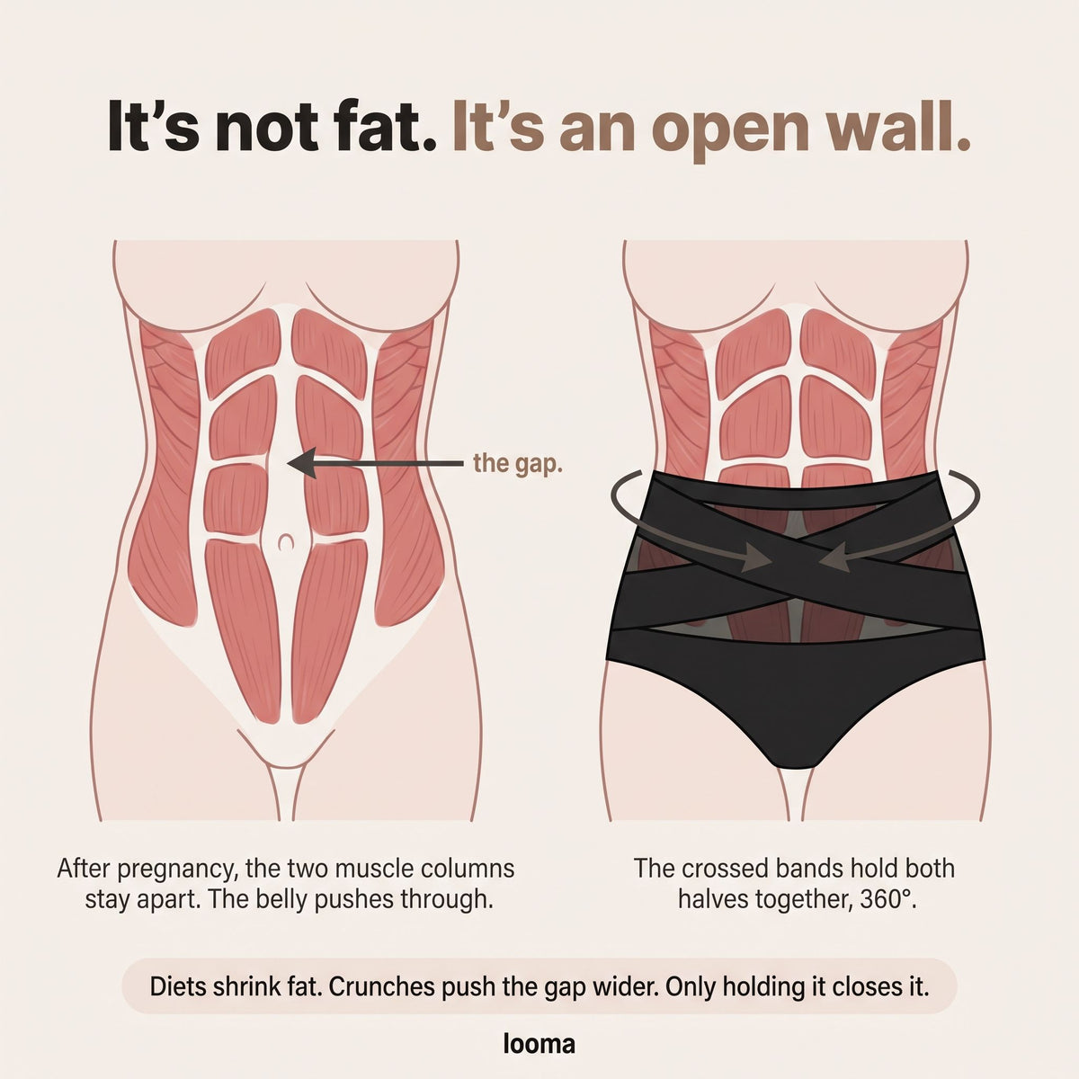 It's not fat, it's an open wall — diastasis explained