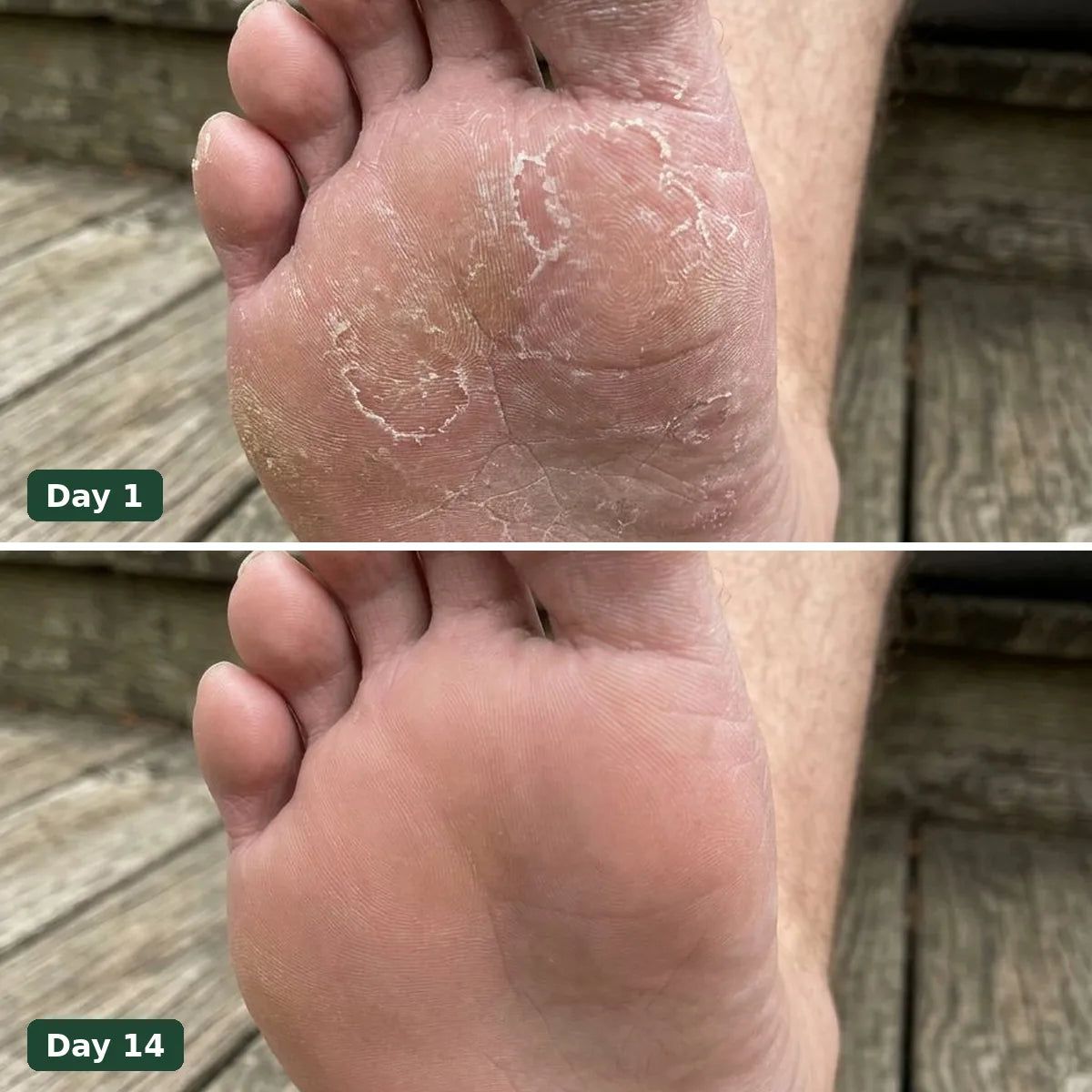 Peeling sole on day 1 and smooth skin on day 14 with Looma