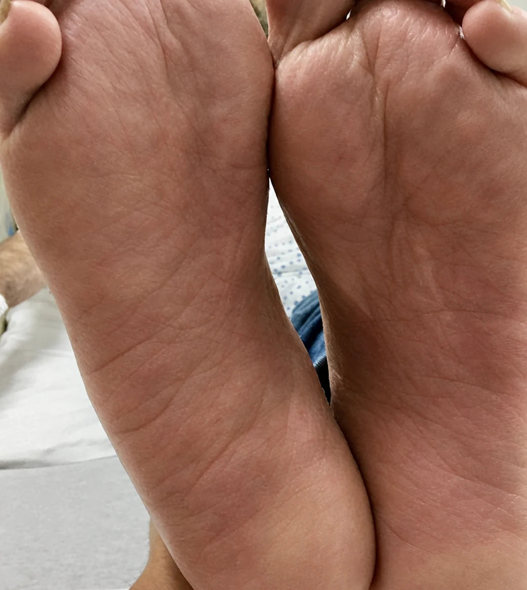 Clear, healthy soles after Looma