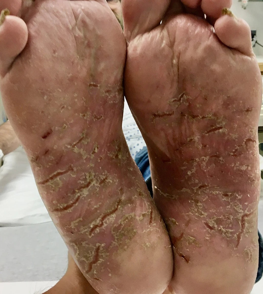Peeling, cracked soles from athlete's foot before Looma