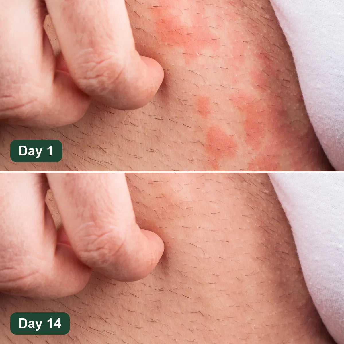 Groin rash on day 1 and clear skin on day 14 with Looma