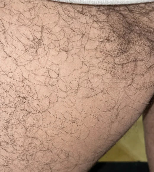 Groin crease after Looma