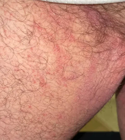 Jock itch rash in the groin crease before Looma