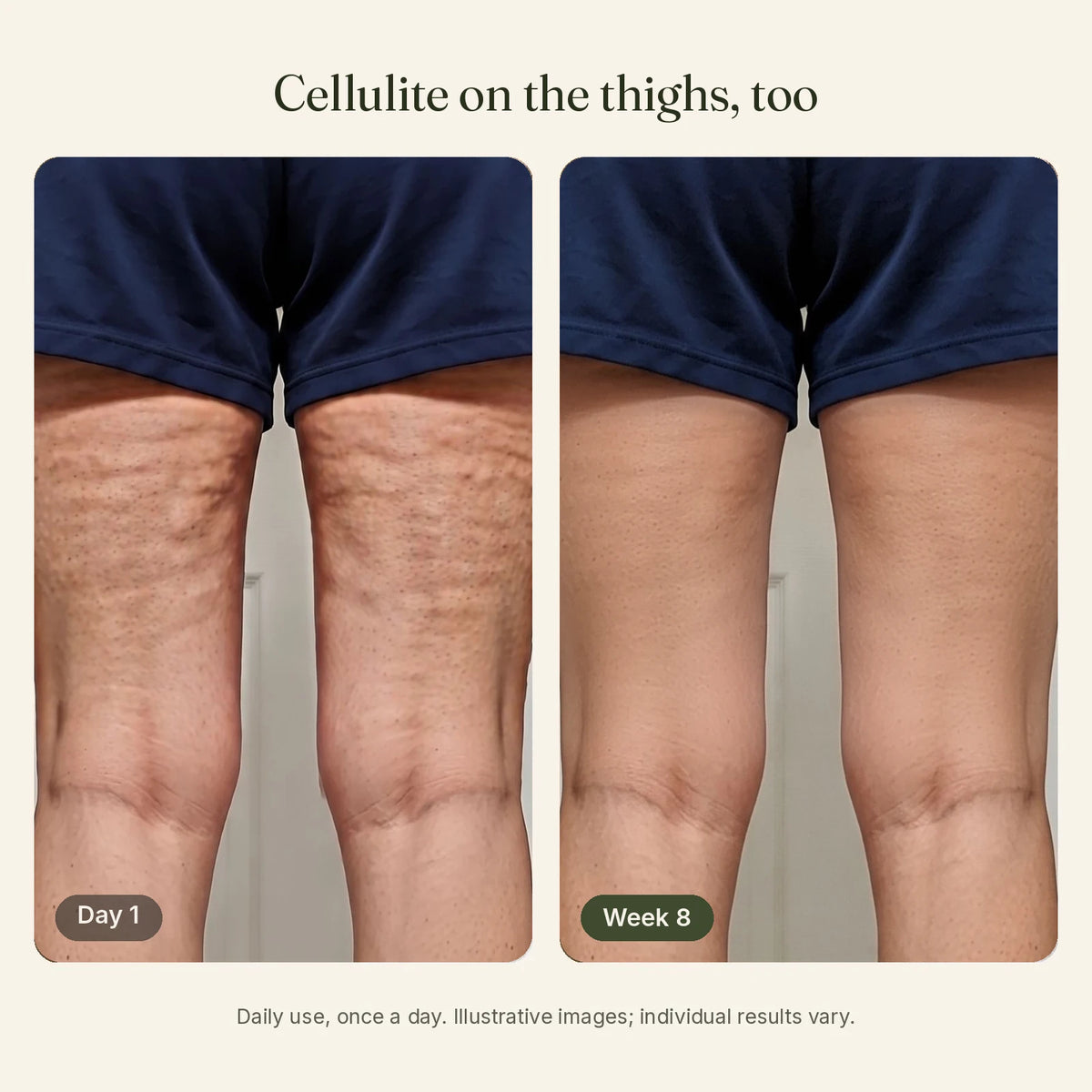 Cellulite on the back of the thighs on day 1 and after 8 weeks of daily use