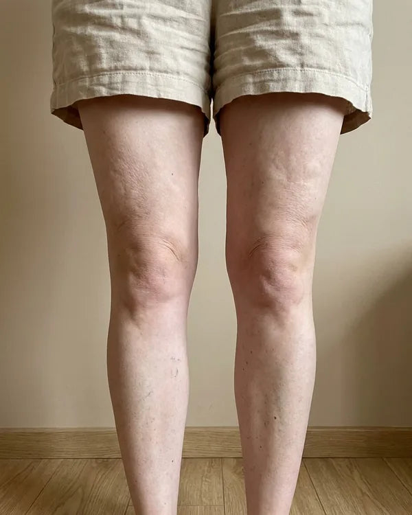 Crepey skin above the knees, day 1